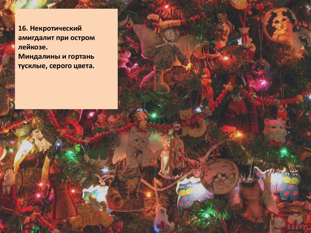 16. Некротический амигдалит при остром лейкозе. Миндалины и гортань тусклые, серого цвета.  