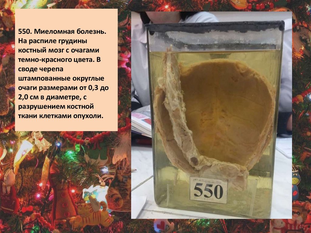 550. Миеломная болезнь. На распиле грудины костный мозг с очагами темно-красного цвета. В своде черепа штампованные округлые очаги размерам