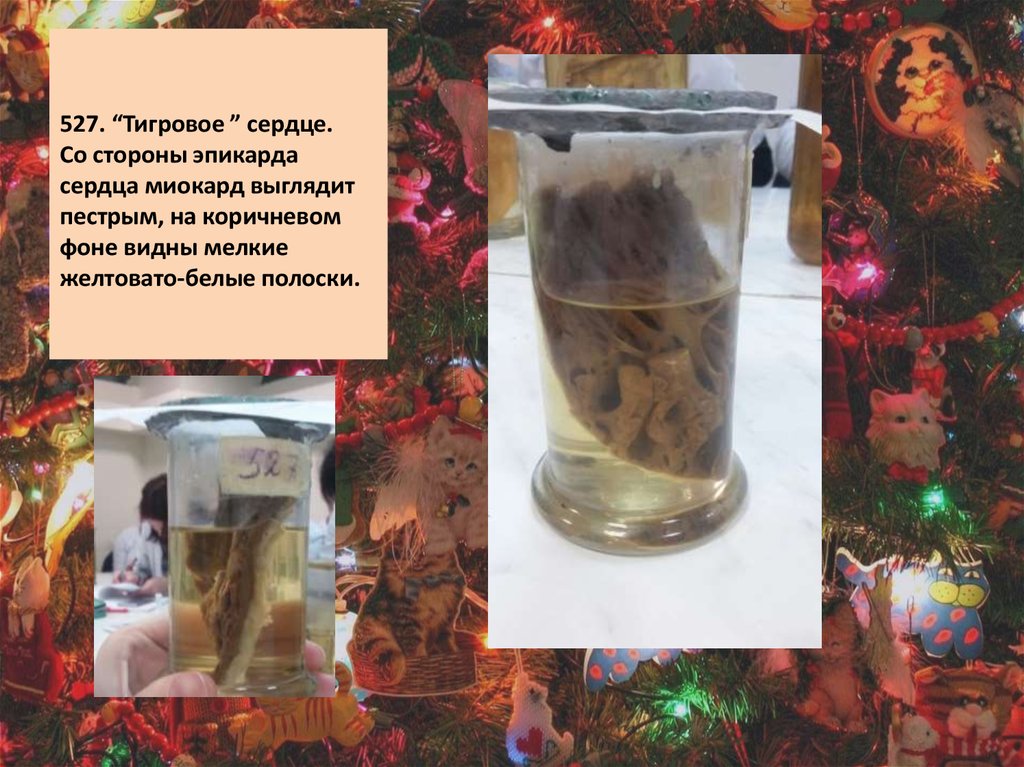   527. “Тигровое ” сердце. Со стороны эпикарда сердца миокард выглядит пестрым, на коричневом фоне видны мелкие желтовато-белые полоски.