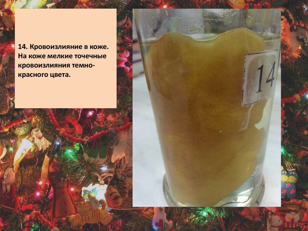   14. Кровоизлияние в коже. На коже мелкие точечные кровоизлияния темно-красного цвета.  