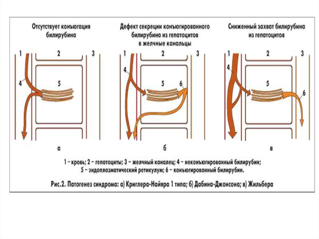 Дабина джонсона. Синдром Дабина Джонсона патогенез. Синдром Жильбера механизм развития. Синдром Жильбера, Дабина-Джонсона. Синдром Жильбера этиология.