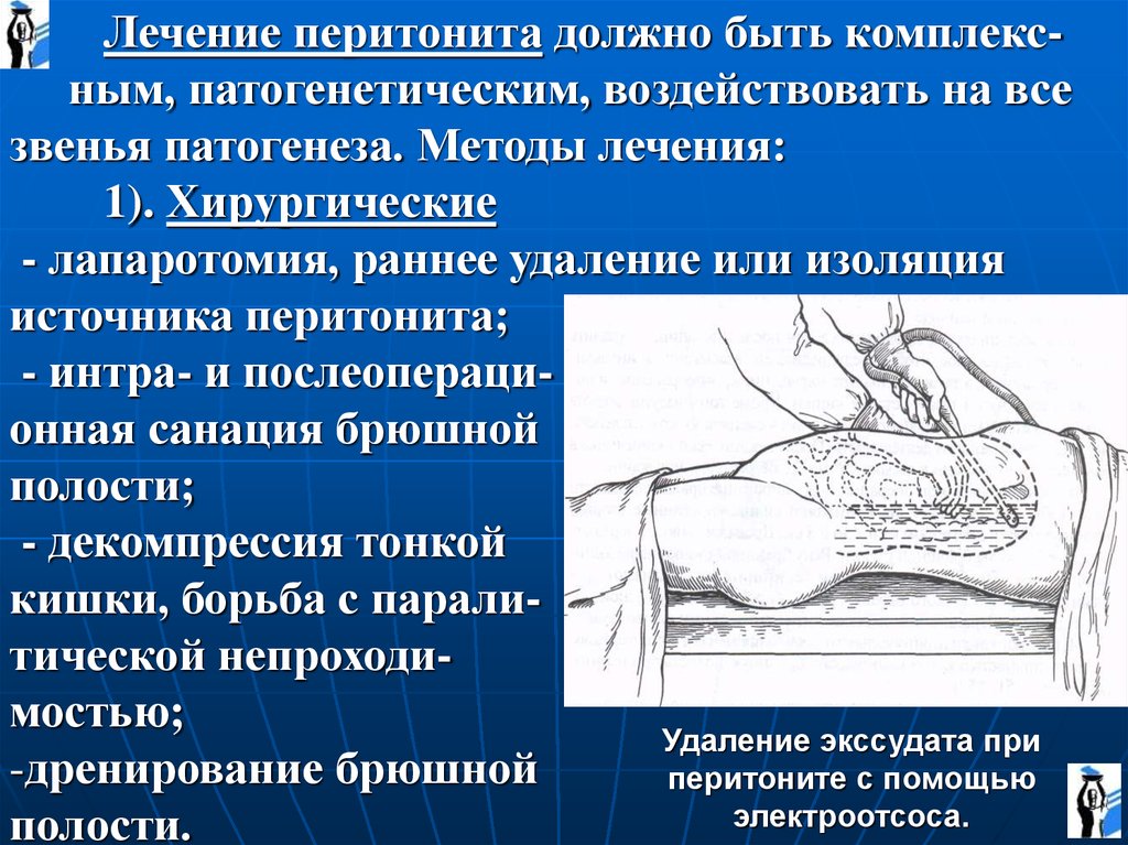 Схема дренирования брюшной полости при перитоните