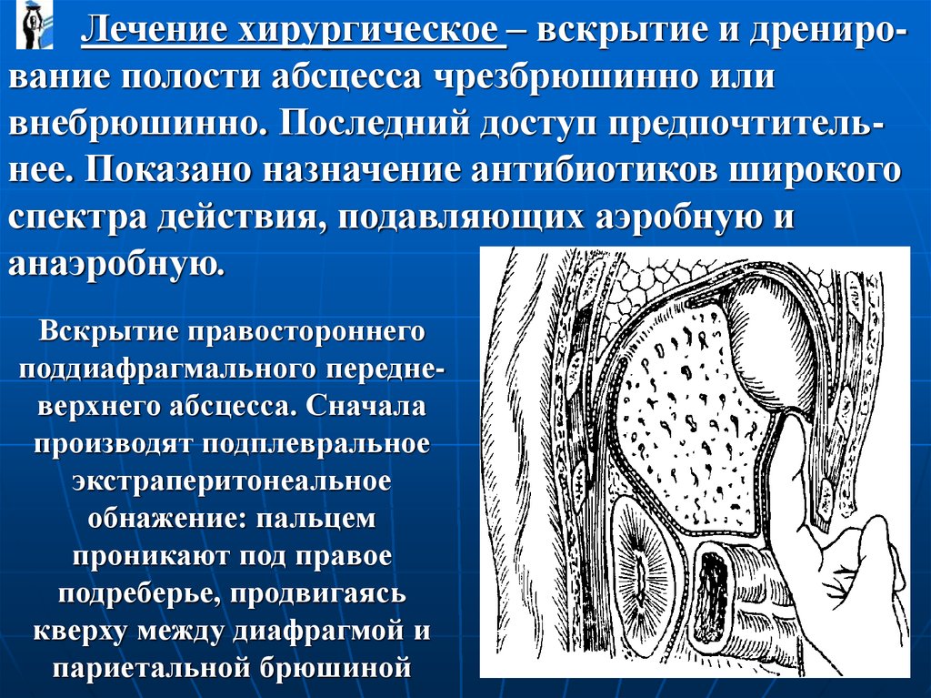 Абсцесс брюшной полости код по мкб 10