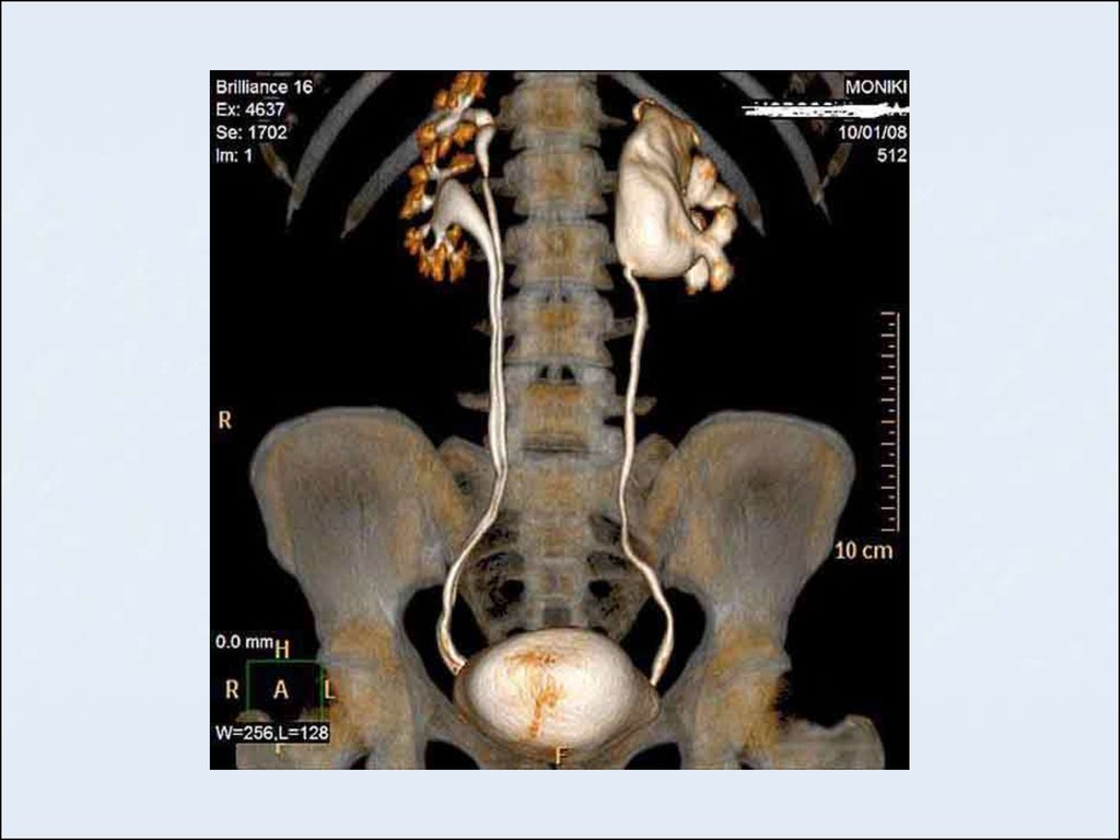 Пиелоэктазия почек это. Гидронефроз почки кт снимок. Кт гидронефроз почки кт. Кт-картина пиелоэктазии почки.