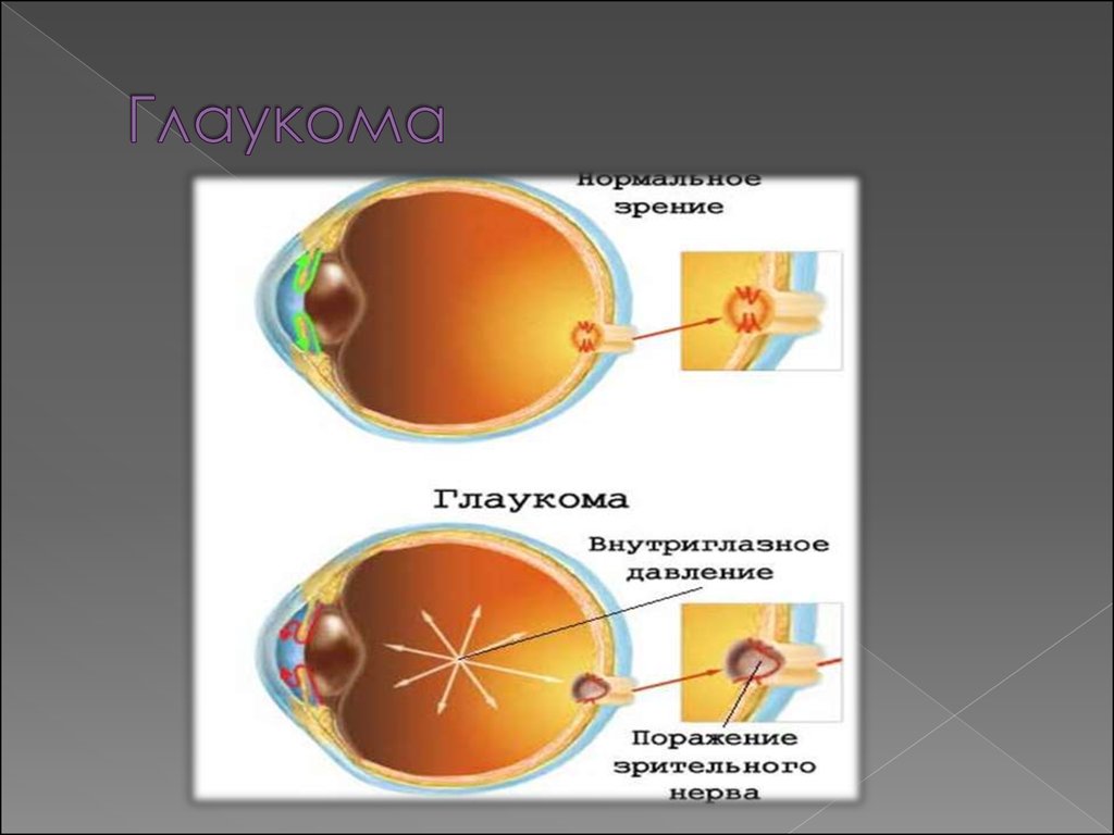 Глаукома