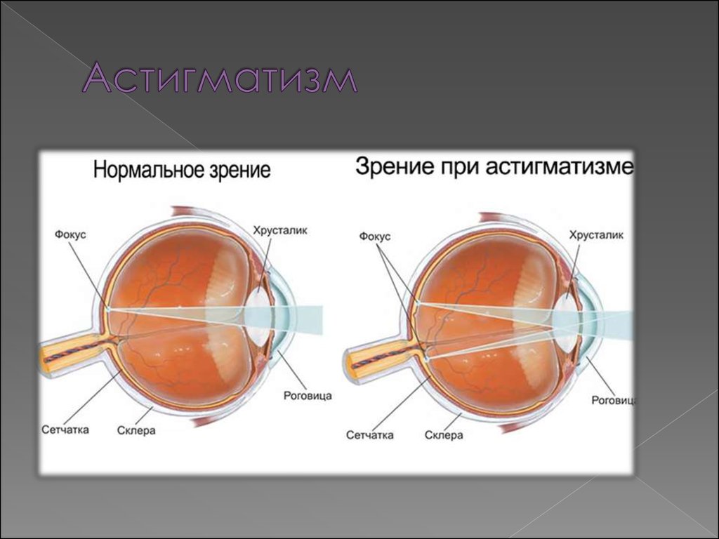 Астигматизм