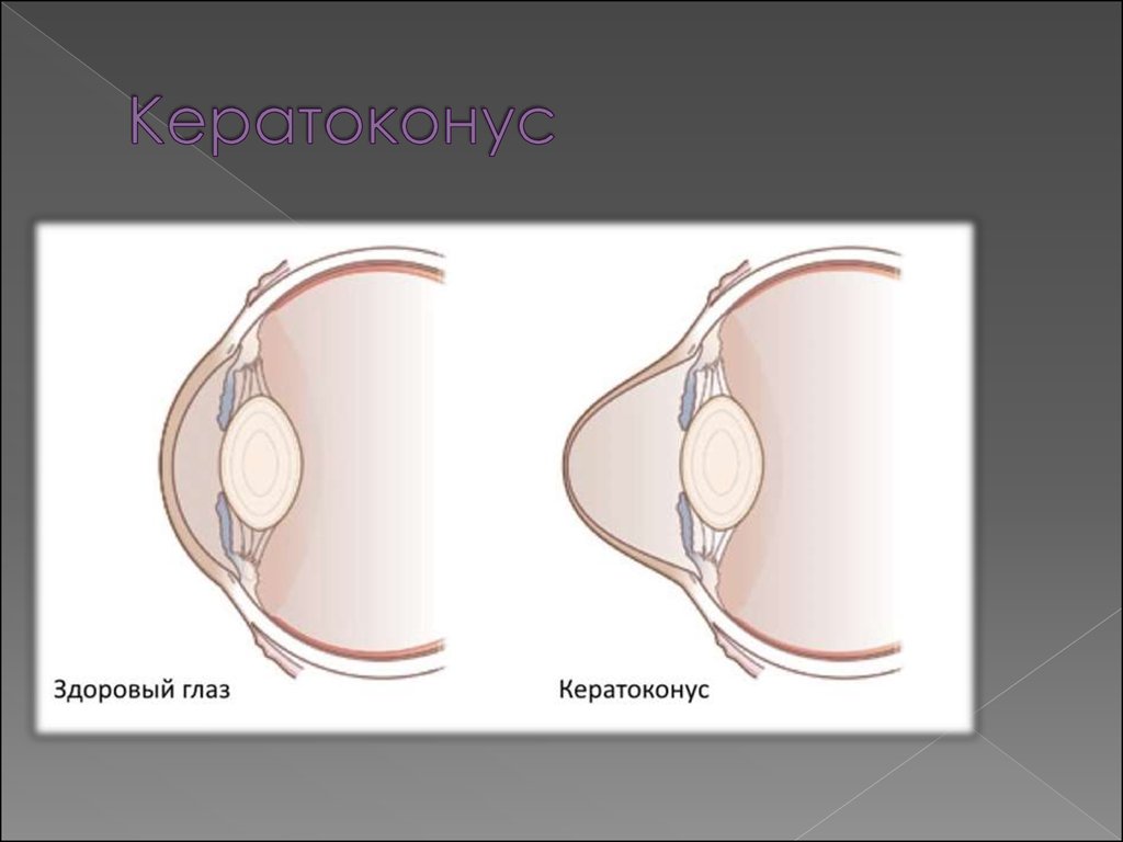 Кератоконус