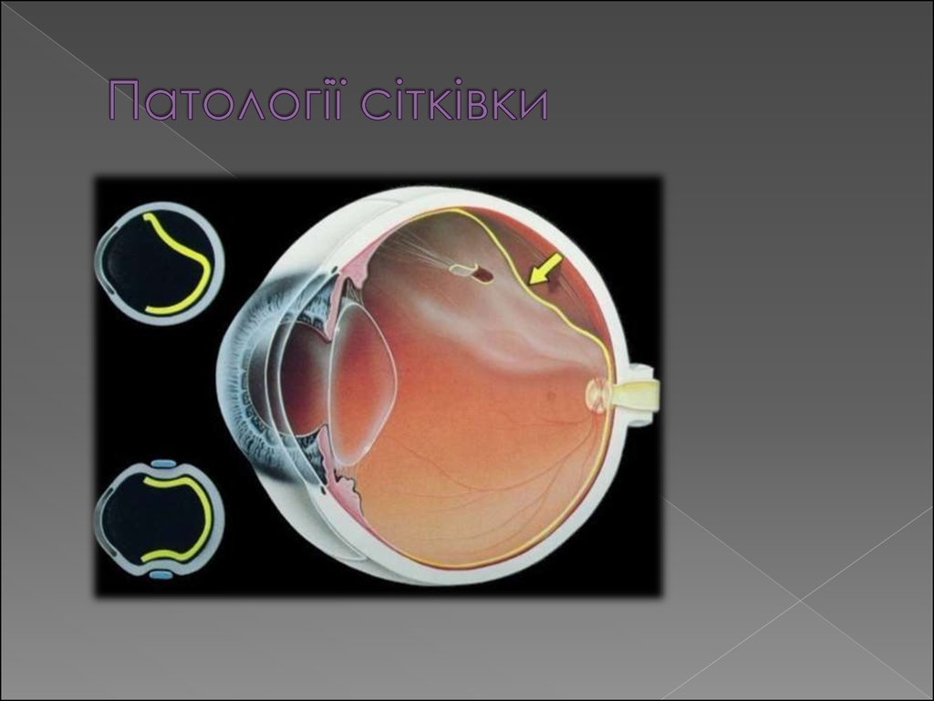 Патології сітківки