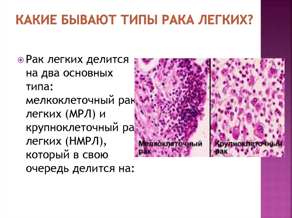 Рак легкого диагностика презентация