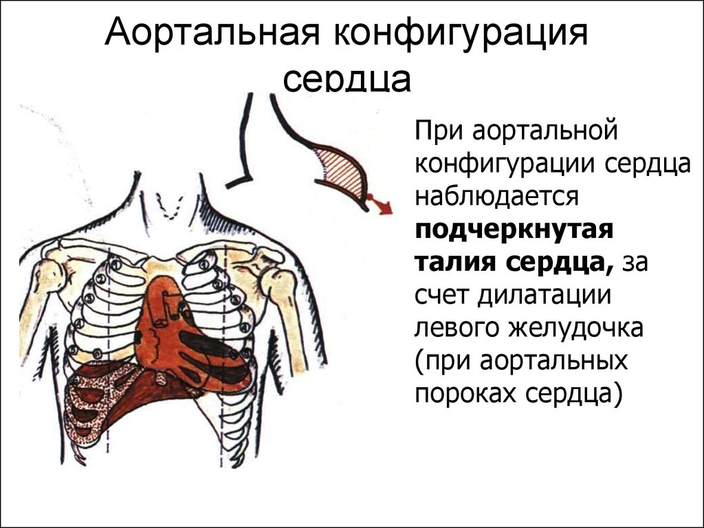 Аортальное сердце. Аортальная конфигурация сердца. Конфигурация сердца при аортальных пороках. Границы контуров сердца при аортальной конфигурации сердца. Митральная и аортальная конфигурация сердца.