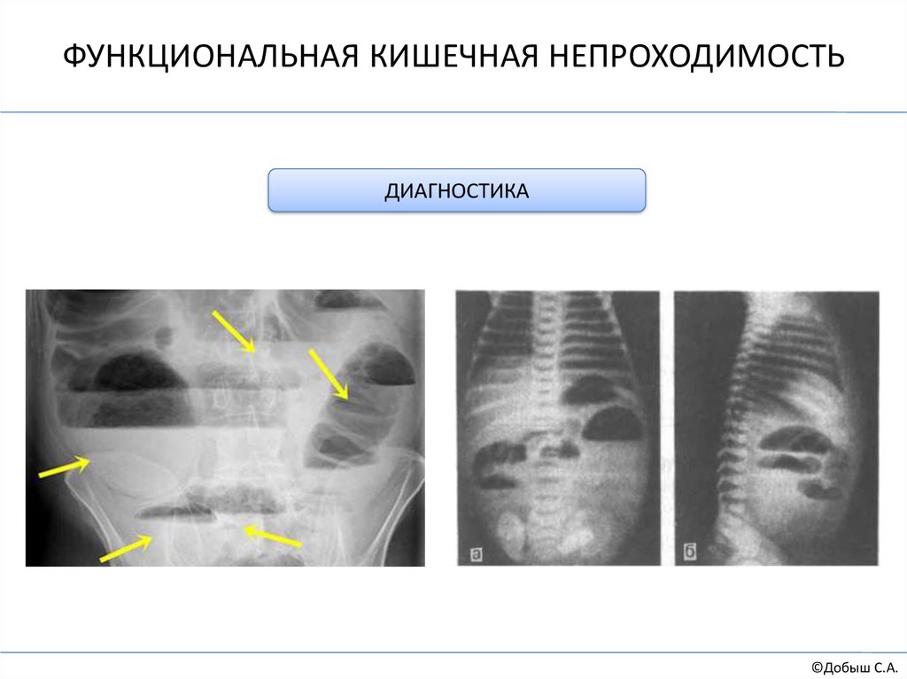 Приобретенная кишечная непроходимость