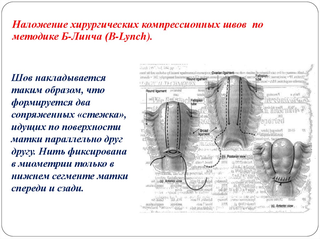 Наложение шва на матку. Компрессионные швы на матку по b-Lynch. Гемостатический компрессионный шов на матку. Компрессионные швы по методике Линча.