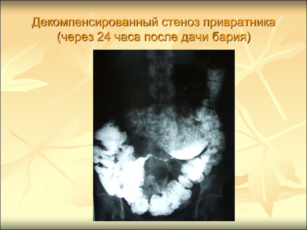 После бария. Рубцовый стеноз привратника рентген. Язвенный стеноз привратника рентген. Степени стеноза привратника рентген. Декомпенсированный пилоростеноз.