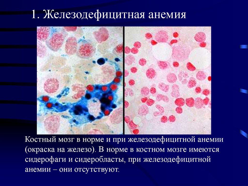 Результаты костного мозга. Железодефицитная анемия мазок крови. Жда анемия картина крови. Изменения костного мозга при железодефицитной анемии.