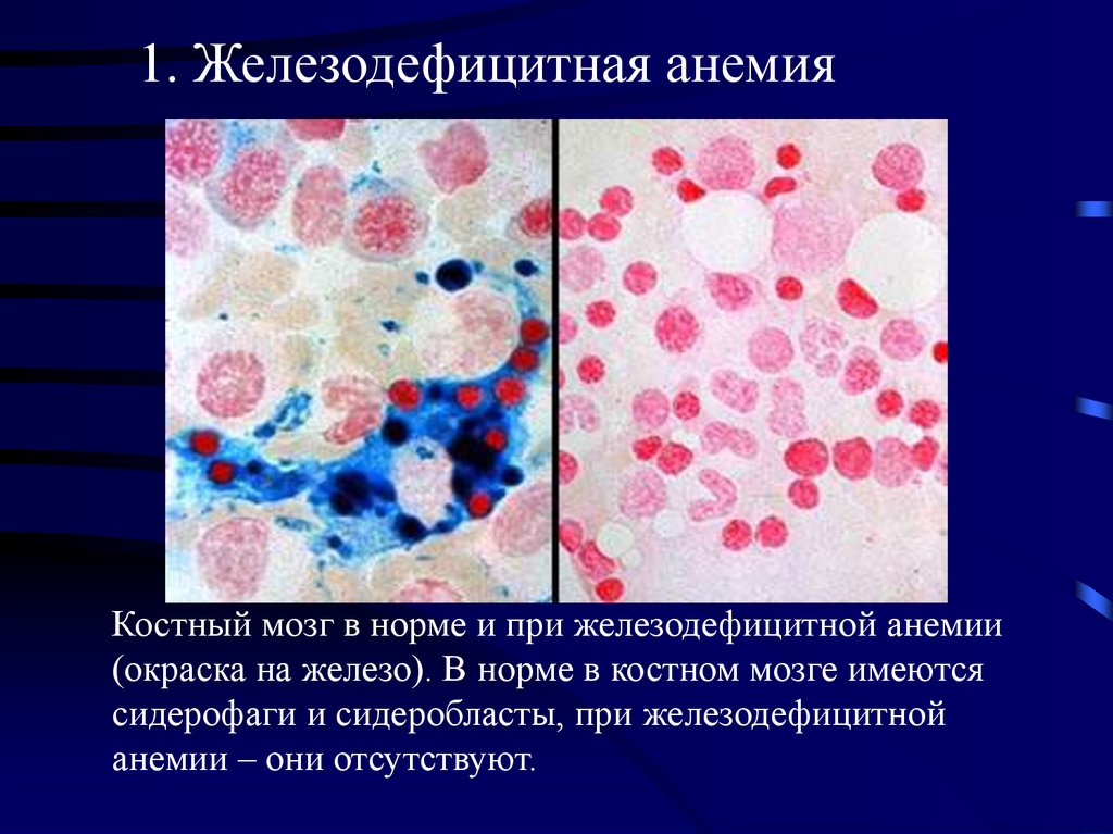 Картина периферической крови при железодефицитной анемии