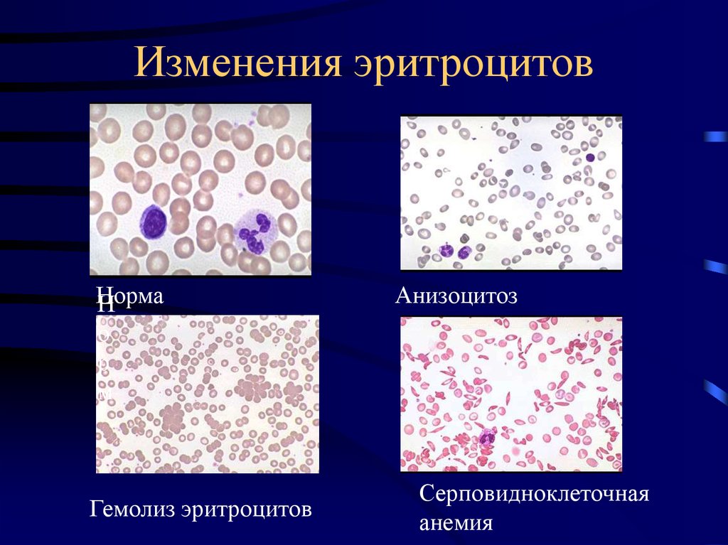 Морфологические изменения в эритроцитах рисунок