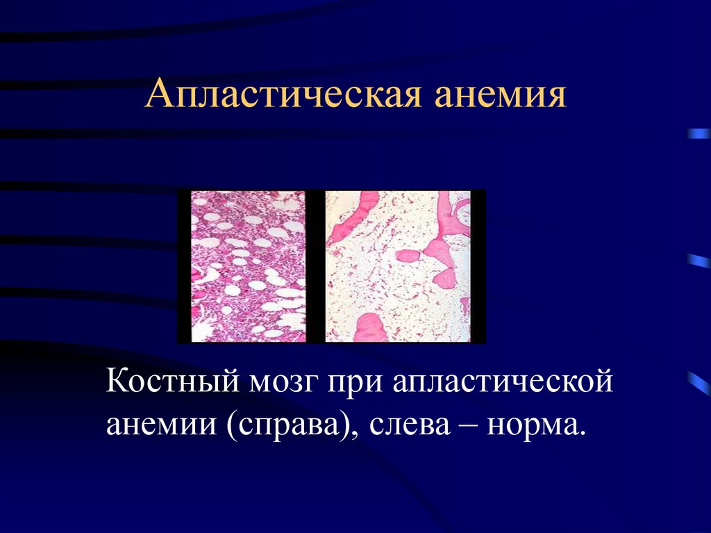 Нарушение развития костного мозга. Апластическая анемия гистология. Апластическая анемия костный мозг. Костный мозг при апластической анемии. Апластическая анемия микропрепарат.