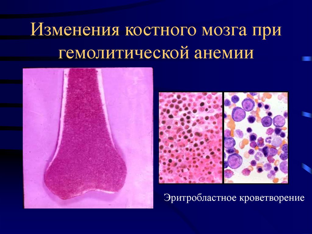 Результаты костного мозга. Мазок крови при гемолитической анемии. Изменения костного мозга. При гемолитической анемии пунктат костного мозга.