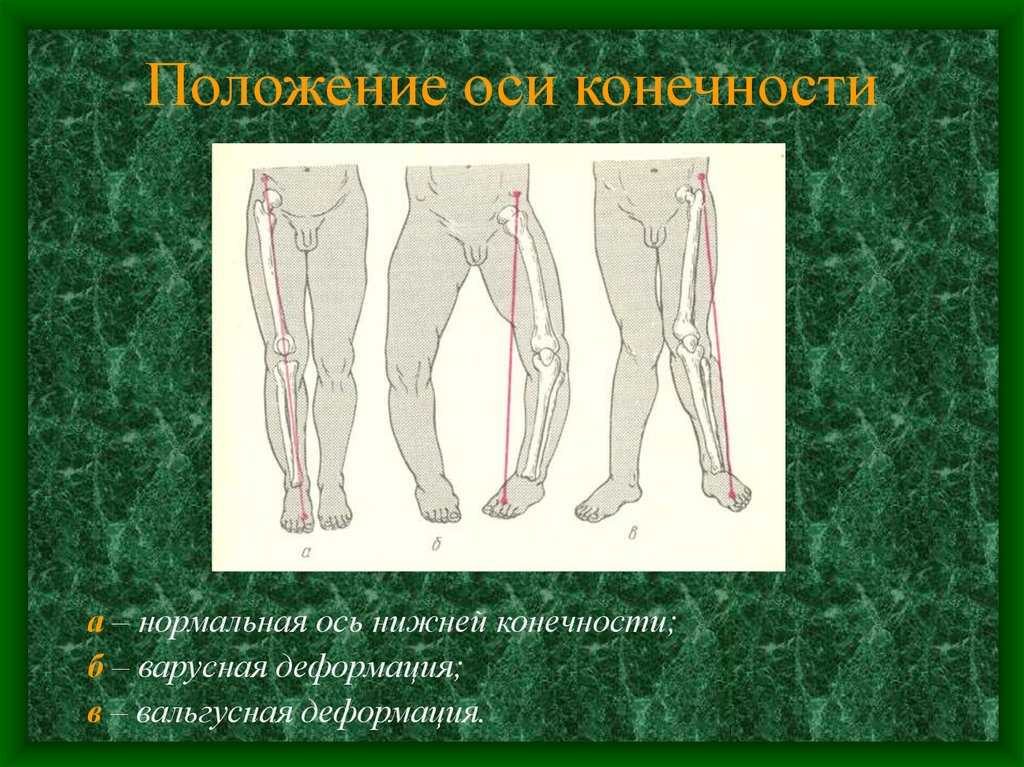 Варусная деформация. Варусная деформация оси нижних конечностей. Нормальная ось нижней конечности. Нарушение оси нижней конечности. Измерение оси нижней конечности.