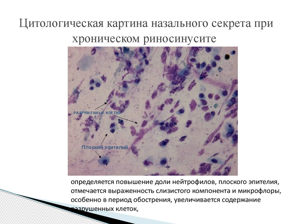 Слизистые клетки секрет. Риноцитограмма микроскопия мазка из носа. Назальный секрет микроскопия. Цитологический анализ назального секрета. Цилиндрический эпителий риноцитограмма.