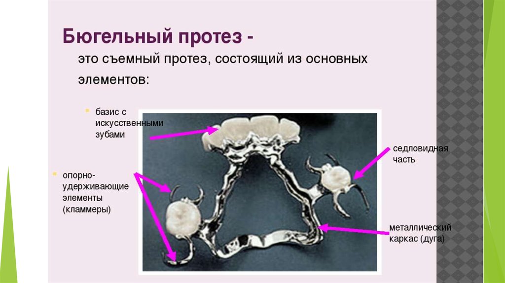 Презентация на тему бюгельный протез