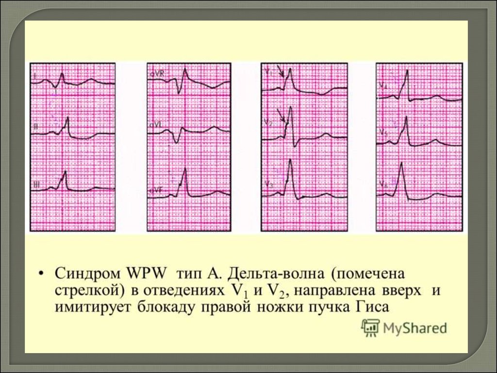 Wpw синдром на экг картинки