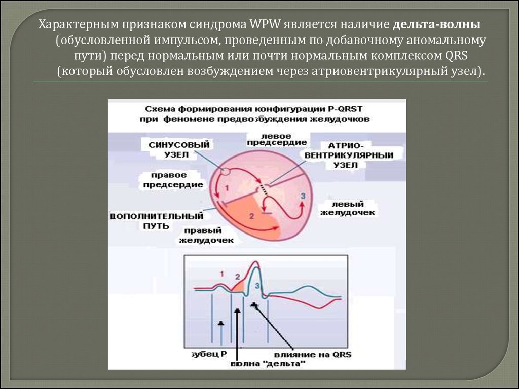 Синдром впв презентация