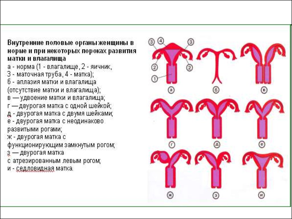 Разновидности женских органов и размеры в картинках. Аномалии развития матки анатомия. Пороки развития матки классификация. Аномалии развития матки классификация. Врожденные пороки развития матки.