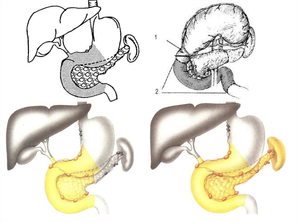 Стадии поджелудочной железы. Онкопатологии поджелудочной железы. Опухоль в поджелудочной железе. Доброкачественная опухоль поджелудочной железы. Опухоли желчных протоков и поджелудочной железы.