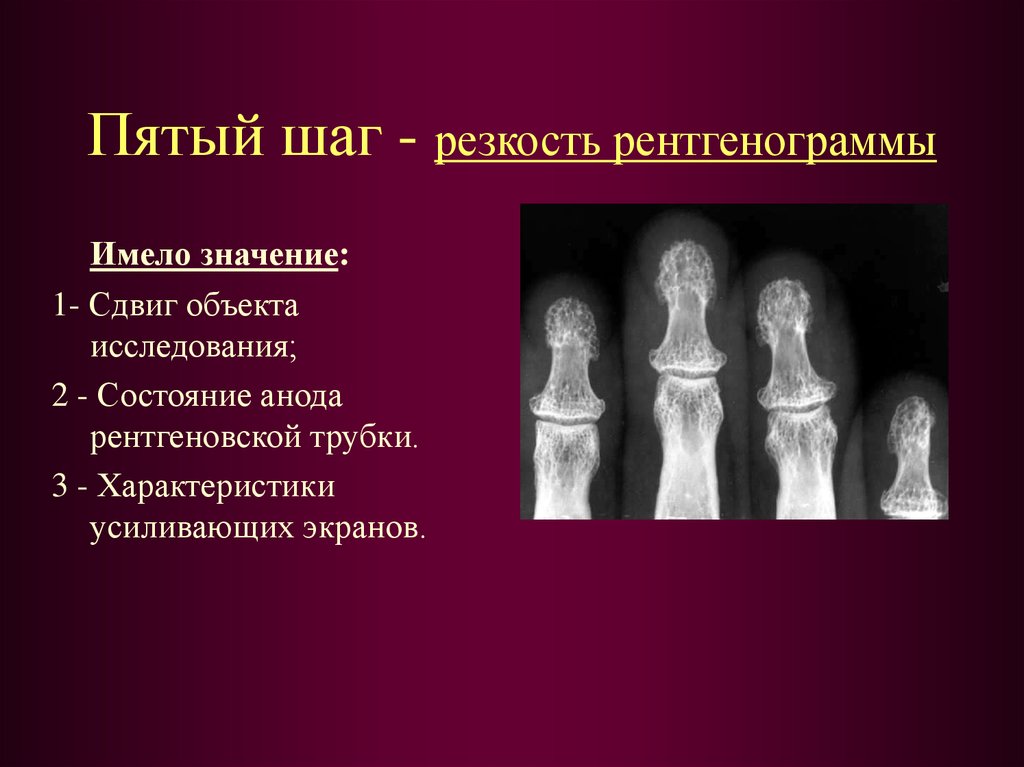 Нерезкость рентгеновского изображения