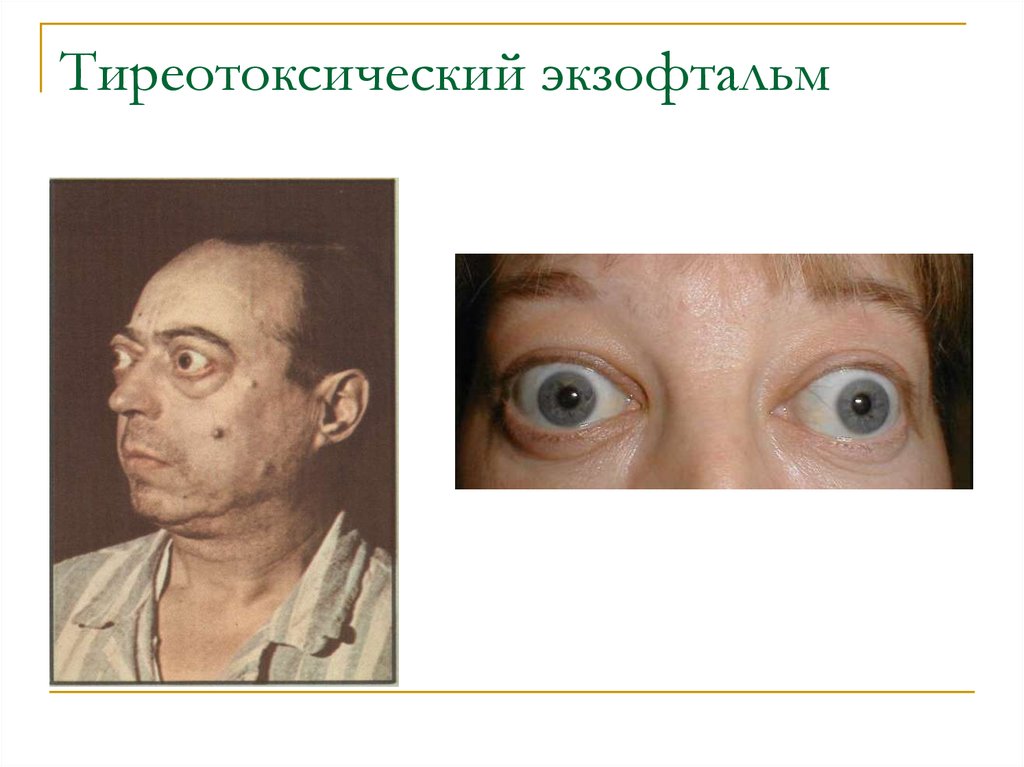 Тиреотоксический экзофтальм