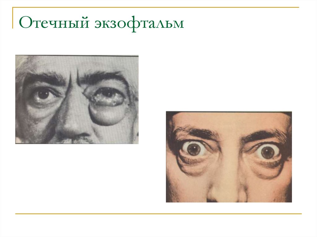 Экзофтальм наблюдается при. Офтальмопатия Грейвса. Эндокринная офтальмопатия глаза. Двухсторонний экзофтальм.