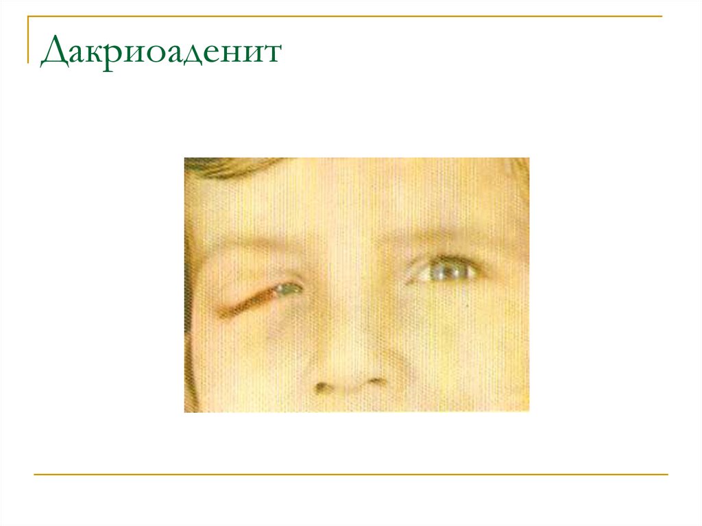 Дакриоаденит