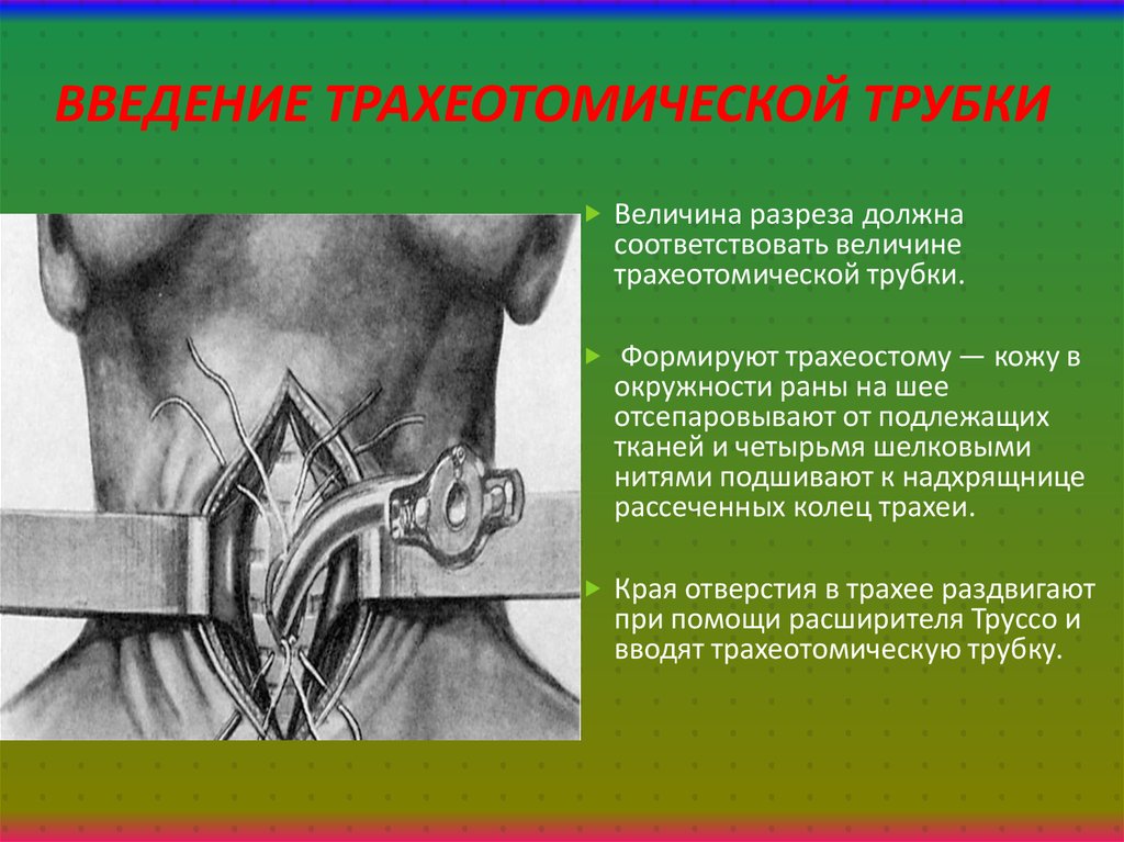 Введение трахеотомической трубки