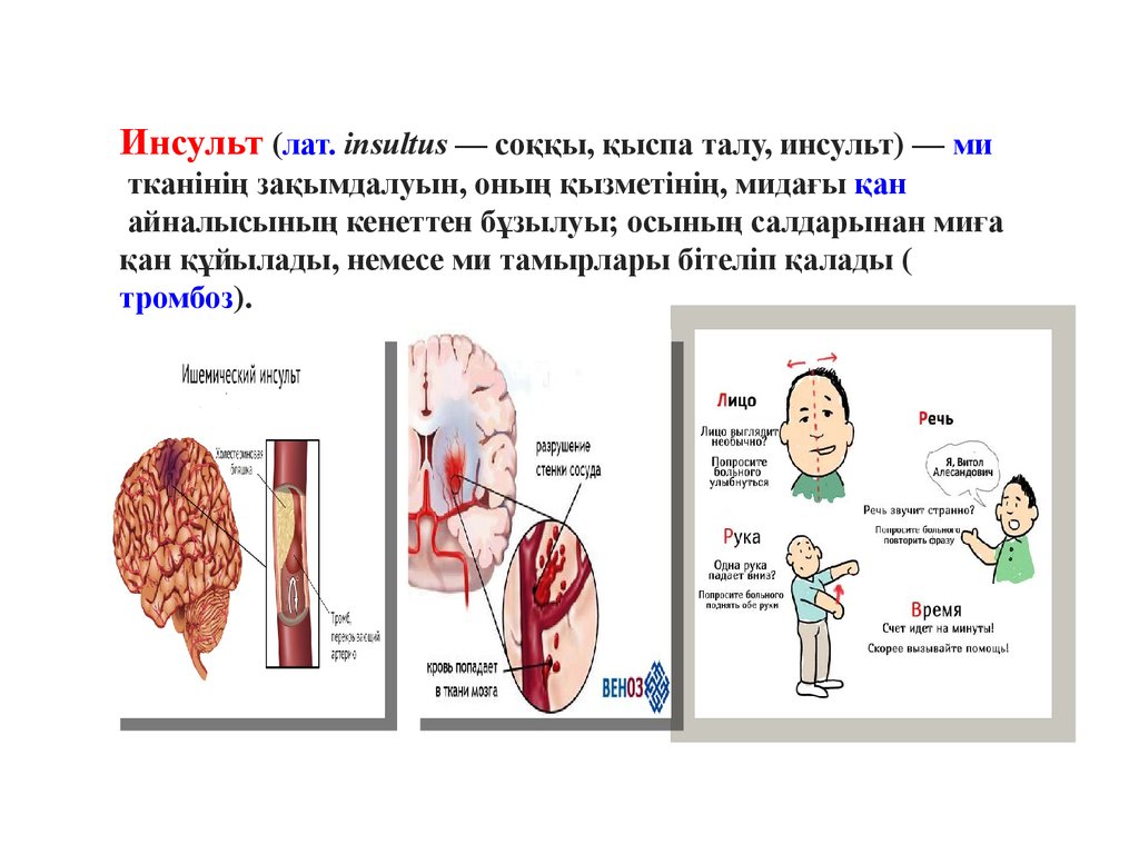 Инсульт дегеніміз не презентация