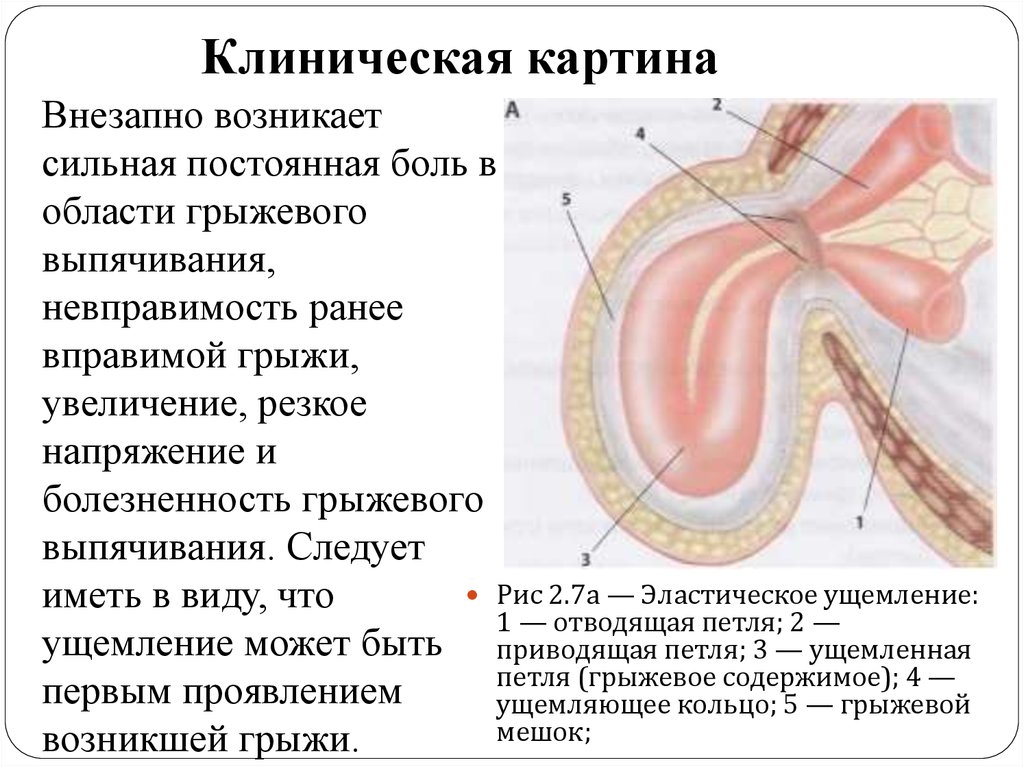 Признаки грыжи. Клиническая картина ущемленной грыжи. Эластическое ущемление грыжи обусловлено?. Вправимые и невправимые грыжи. Ущемление грыжи клиническая картина.