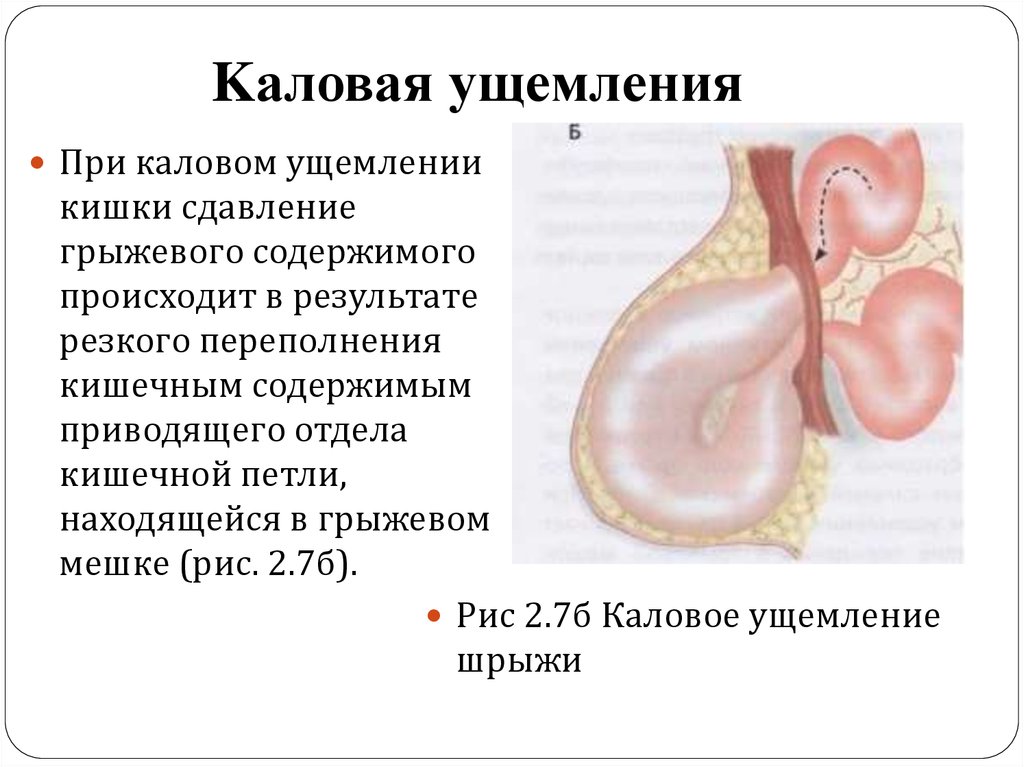 Этапы ущемленной грыжи