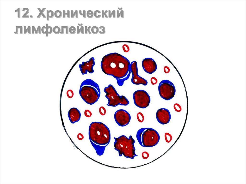 Картина крови при онкологии