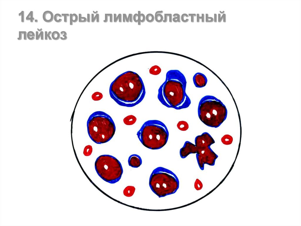 Острый лейкоз картина крови