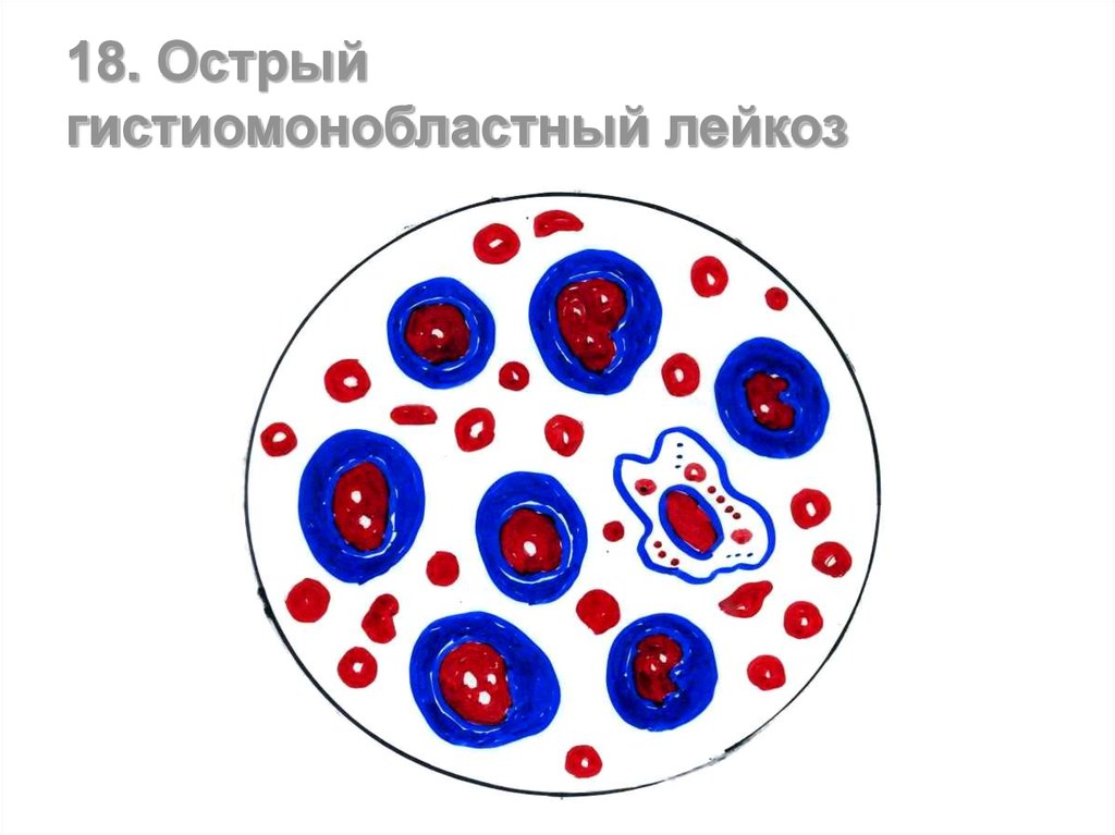 Острый лейкоз картина крови