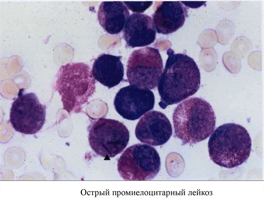 Картина острого лейкоза