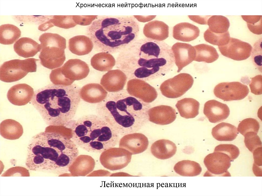 Хронический моноцитарный лейкоз. Лейкемоидная реакция картина крови. Картина крови при лейкемоидных реакциях. Хронический эозинофильный лейкоз картина крови.