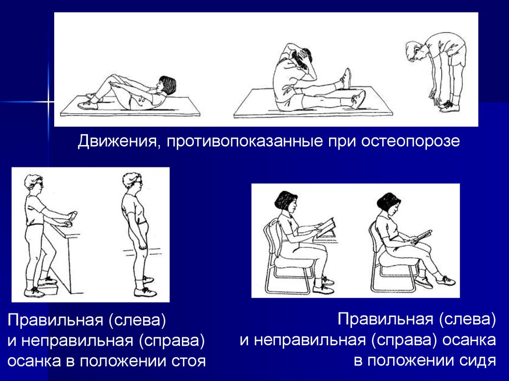 Гимнастика при остеопорозе позвоночника. Движения, противопоказанные при остеопорозе. Упражнения для больных остеопорозом. Упражнения для профилактики остеопороза. Остеопороз позвоночника гимнастика.