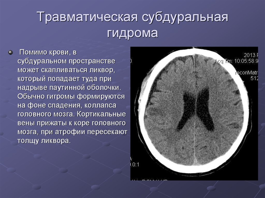 Признаки атрофии головного мозга. Хроническая субдуральная гигрома. Подострая субдуральная гематома на кт. Субдуральная гематома головного мозга кт. Хроническая гигрома головного мозга на кт.