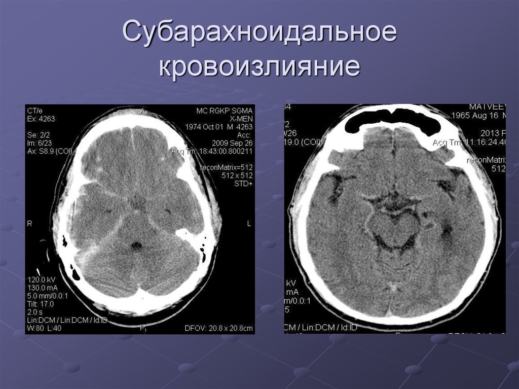 Постоперационные изменения головного мозга при компьютерной томографии