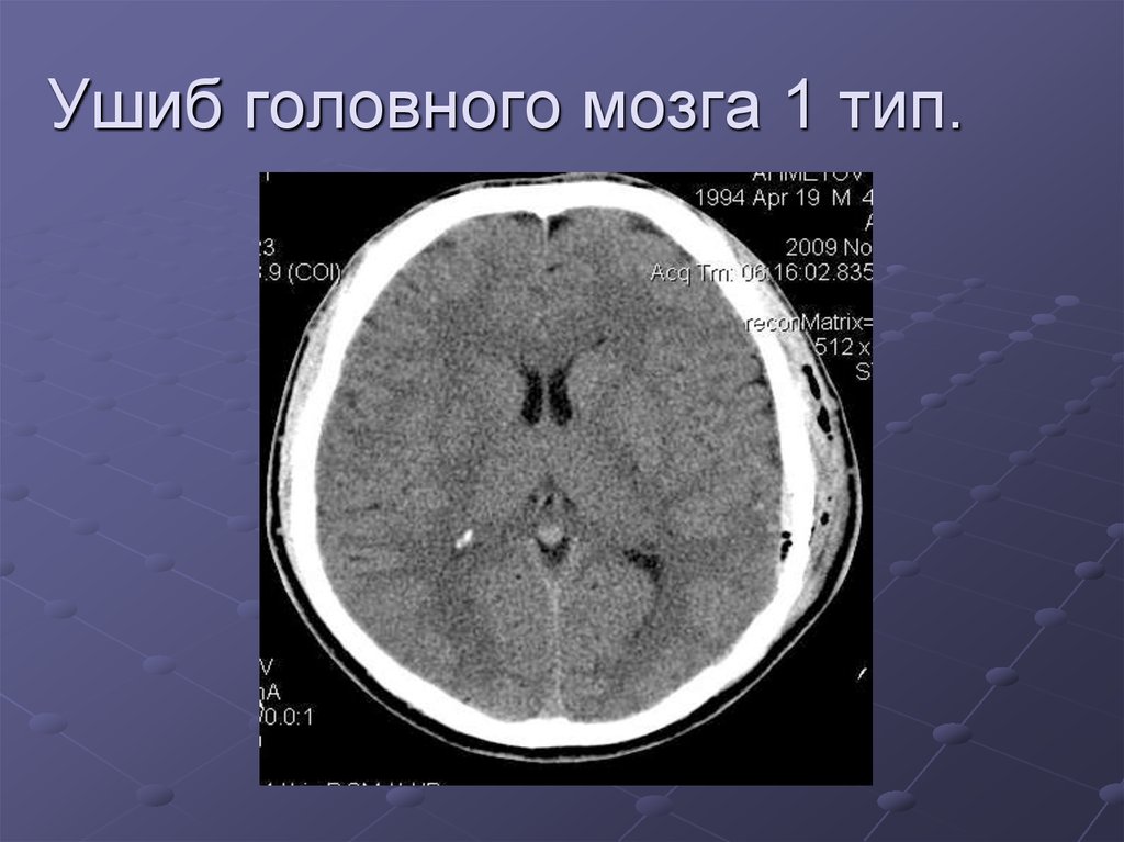 Ушиб головного мозга 1 тип.