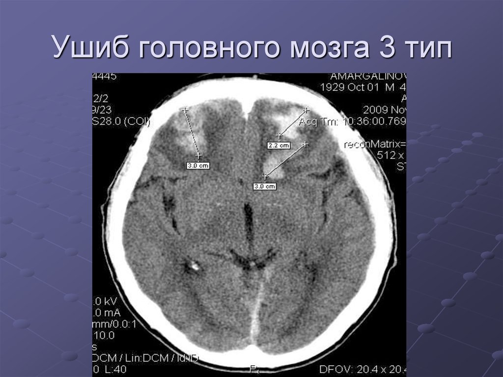 Ушиб головного мозга 3 тип
