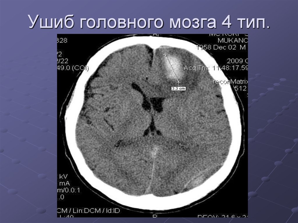 Ушиб головного мозга. Ушиб головного мозга на кт 4 типа. Контузионные очаги головного мозга на кт. Кт признаки ушиба головного мозга легкой степени.