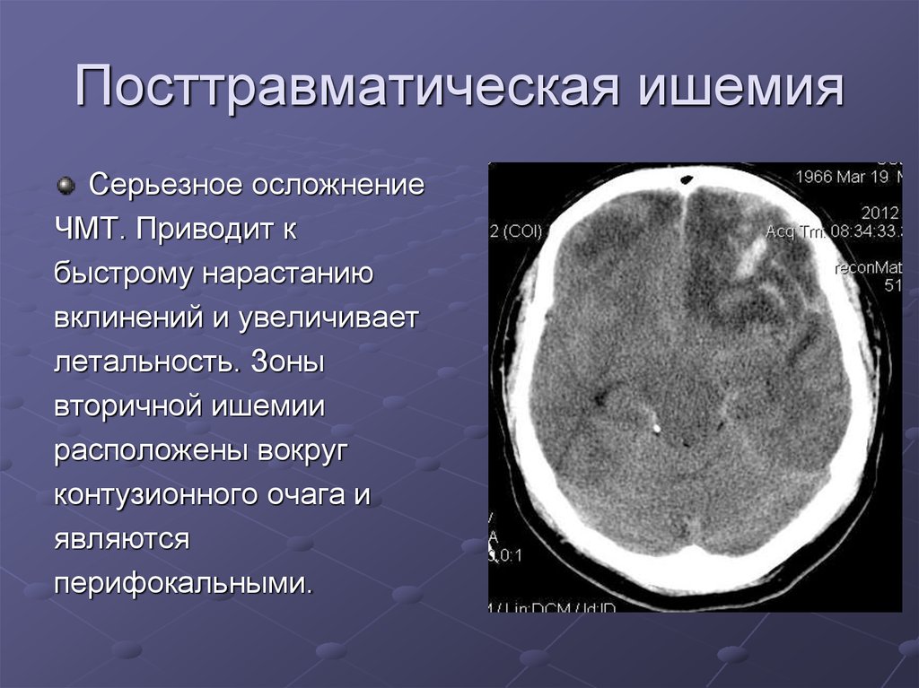 Ишемия мозга. Контузионный очаг головного мозга кт. Контузионные очаги ЧМТ кт. Контузионные очаги головного мозга на кт. Геморрагический контузионный очаг на кт.