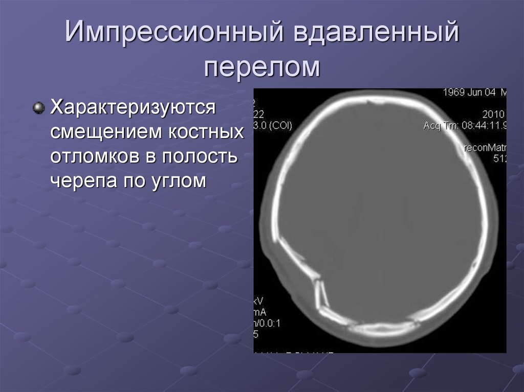 Импрессионный перелом. Импрессионный перелом черепа на кт. Импрессионный вдавленный перелом свода черепа. Импрессионный перелом теменной кости. Вдавленные переломы костей черепа.